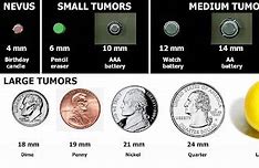 Image result for How Big Is a 12 Cm Tumor