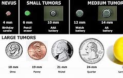 Image result for How Big Is a 10Mm Tumor