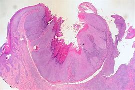 Image result for Skin Molluscum