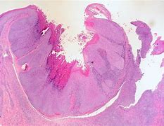 Image result for Mucosa Contagiosum