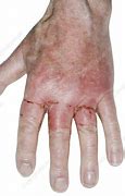 Image result for Acid Burn Hand