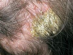 Image result for Eczema Under Microscope