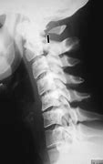 Image result for Posterior Rachischisis