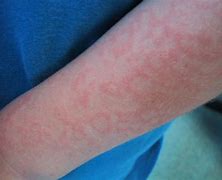 Image result for Fifth Disease Rash On Arms