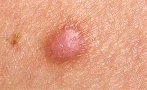 Image result for Hard Raised Bump On Skin