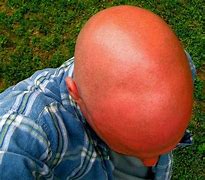 Image result for Sun Burn On Bald Head
