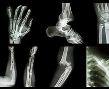 Image result for Broken Bone X-ray