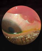 Image result for Conjunctival Papilloma