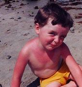 Image result for SunBurn for Kids