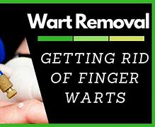 Image result for Warts On Hands Treatment