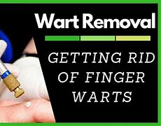 Image result for Hand Wart Removed