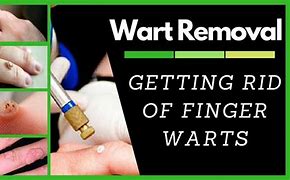 Image result for Best Wart Removal