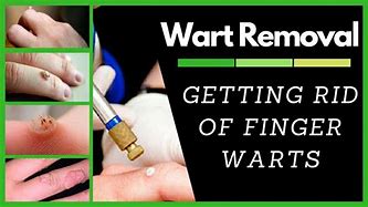 Image result for Finger Wart Removal