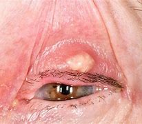 Image result for Retention Cyst Eyelid