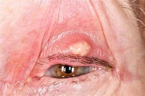 Image result for Chalazion Inner Eyelid