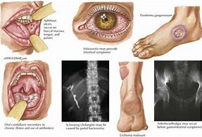 Image result for Extraintestinal Manifestations of UC