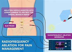 Image result for Radiofrequency Ablation Needle