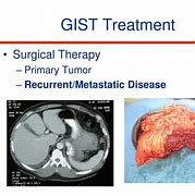 Image result for Gist Tumor Surgery