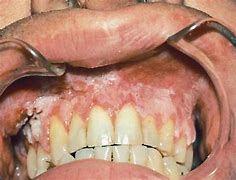 Image result for Squamous Cell Carcinoma Mandible