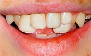 Image result for Messed Up Teeth