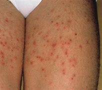 Image result for Folliculitis On Thighs