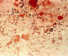 Image result for Neisseria Gonorrhoeae Under Microscope