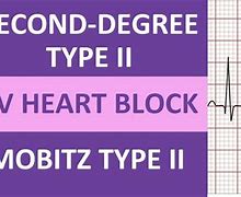 Image result for Mobitz Type 2 with STEMI