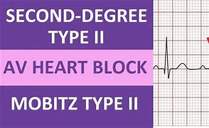 Image result for Mobitz Type 2 vs Complete Heart Block