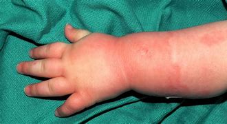 Image result for Child Third-Degree Burn