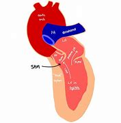 Image result for Sam of Mitral Valve