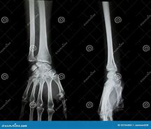 Image result for Arm X-ray