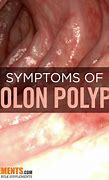 Image result for Signs of Colon Polyps