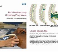Image result for Spina Bifida and Anencephaly