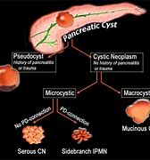 Image result for Pancreas Pathology