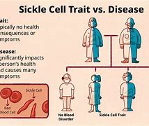 Image result for Heterozygous Sickle Cell Disease