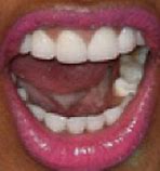 Image result for Nicki Minaj Yellow Teeth