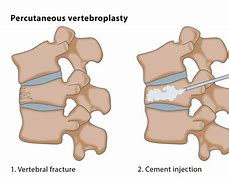 vertebroplasty 的图像结果