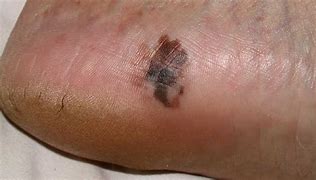 Image result for Melanoma On Foot