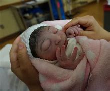 Image result for What Is Anencephaly Baby
