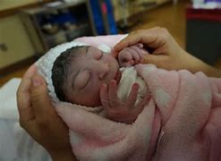 Image result for Babies Born with Anencephaly