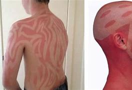 Image result for Purple SunBurn