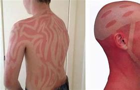 Image result for Severe Sunburn