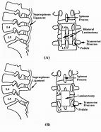 Image result for Lumbar Spine Laminectomy