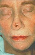 Image result for Skin Cancer Removed From Helix