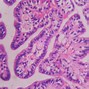Image result for Choroid Plexus Papilloma