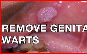 Image result for Genital Wart After Removal