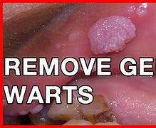 Image result for Genital Warts Removal Disease