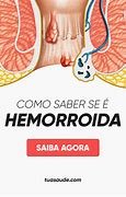 Image result for hemorroida