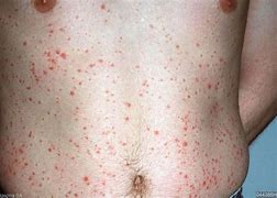 Image result for Psoriasis Papules