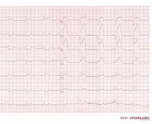Image result for Anterior Myocardial Infarction ECG